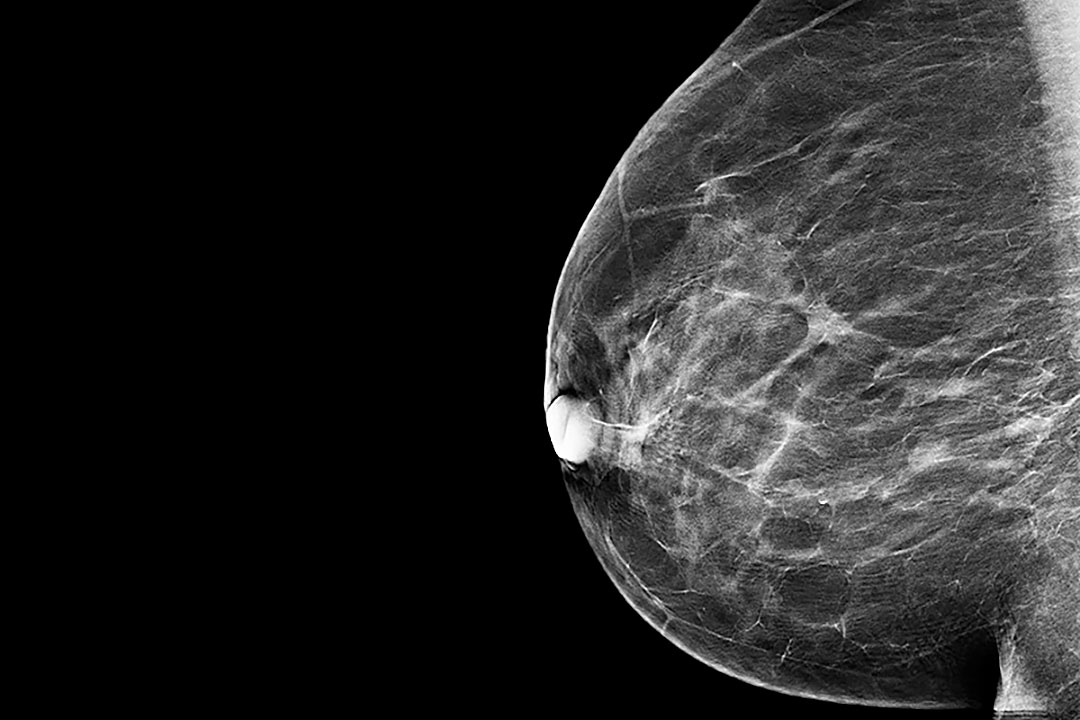 mammografiya 05